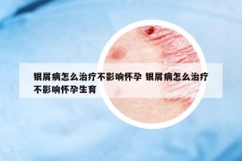 銀屑病怎么治療不影響懷孕 銀屑病怎么治療不影響懷孕生育