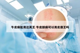 牛皮癬能用達芙王 牛皮膚癬可以用皮康王嗎