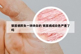銀屑病欺負(fù)一塊塊白的 銀屑病成白色嚴(yán)重了嗎