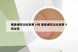 銀屑病可以吃青蘿卜嗎 銀屑病可以吃青蘿卜嗎女性