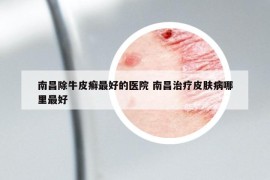 南昌除牛皮癬最好的醫(yī)院 南昌治療皮膚病哪里最好