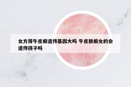 女方得牛皮癬遺傳基因大嗎 牛皮膚癬女的會(huì)遺傳孩子嗎