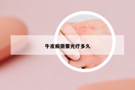 牛皮癬需要光療多久