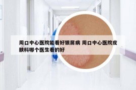 周口中心醫(yī)院能看好銀屑病 周口中心醫(yī)院皮膚科哪個醫(yī)生看的好