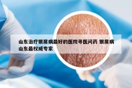 山東治療銀屑病最好的醫(yī)院尋醫(yī)問(wèn)藥 銀屑病山東最權(quán)威專家