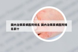 國內(nèi)治銀屑病醫(yī)院排名 國內(nèi)治銀屑病醫(yī)院排名前十