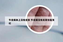 牛皮癬身上沒有皮損 牛皮癬沒有皮屑但是發(fā)紅