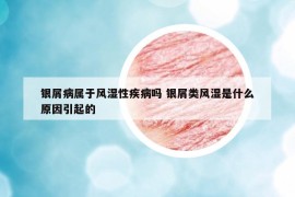 銀屑病屬于風(fēng)濕性疾病嗎 銀屑類風(fēng)濕是什么原因引起的