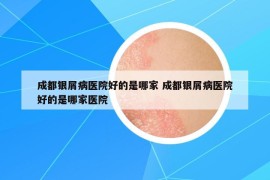 成都銀屑病醫(yī)院好的是哪家 成都銀屑病醫(yī)院好的是哪家醫(yī)院