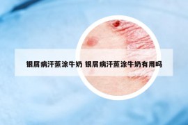 銀屑病汗蒸涂牛奶 銀屑病汗蒸涂牛奶有用嗎