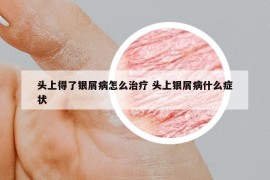 頭上得了銀屑病怎么治療 頭上銀屑病什么癥狀