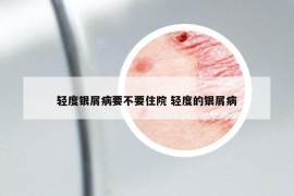 輕度銀屑病要不要住院 輕度的銀屑病