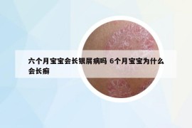 六個(gè)月寶寶會(huì)長(zhǎng)銀屑病嗎 6個(gè)月寶寶為什么會(huì)長(zhǎng)癬