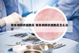 銀屑病鱗狀細胞高 銀屑病鱗狀細胞高怎么治療