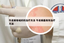 牛皮癬有啥好的治療方法 牛皮癬最有效治療方法