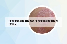 手指甲銀屑病治療方法 手指甲銀屑病治療方法圖片