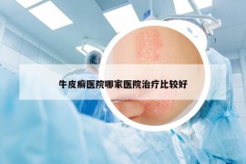 牛皮癬醫(yī)院哪家醫(yī)院治療比較好