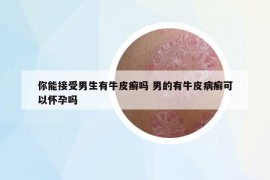 你能接受男生有牛皮癬嗎 男的有牛皮病癬可以懷孕嗎