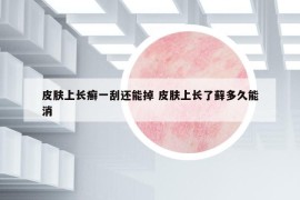 皮膚上長癬一刮還能掉 皮膚上長了蘚多久能消