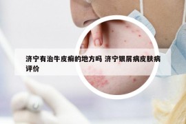 濟寧有治牛皮癬的地方嗎 濟寧銀屑病皮膚病評價
