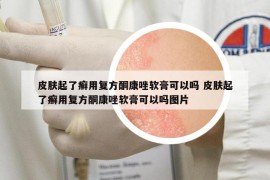 皮膚起了癬用復方酮康唑軟膏可以嗎 皮膚起了癬用復方酮康唑軟膏可以嗎圖片