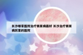 長沙哪家醫(yī)院治療銀屑病最好 長沙治療銀屑病厲害的醫(yī)院