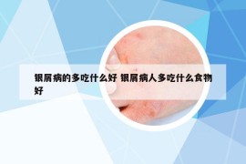 銀屑病的多吃什么好 銀屑病人多吃什么食物好