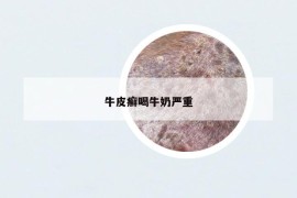 牛皮癬喝牛奶嚴(yán)重