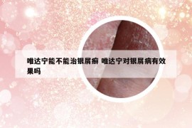 唯達寧能不能治銀屑癬 唯達寧對銀屑病有效果嗎