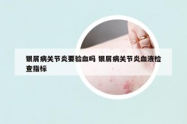 銀屑病關(guān)節(jié)炎要驗血嗎 銀屑病關(guān)節(jié)炎血液檢查指標(biāo)