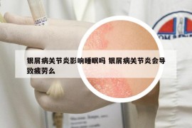 銀屑病關節(jié)炎影響睡眠嗎 銀屑病關節(jié)炎會導致疲勞么