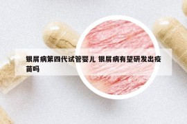 銀屑病第四代試管嬰兒 銀屑病有望研發(fā)出疫苗嗎