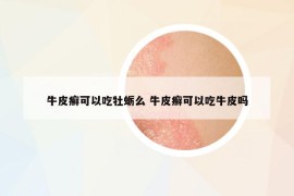 牛皮癬可以吃牡蠣么 牛皮癬可以吃牛皮嗎