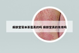 癬膚堂菊米茶是真的嗎 癬膚堂真的有用嗎