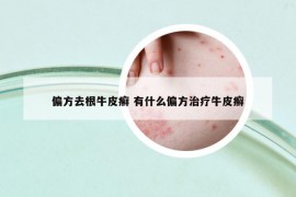 偏方去根牛皮癬 有什么偏方治療牛皮癬