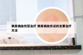 銀屑病血熱型治療 銀屑病血熱證的主要治療方法