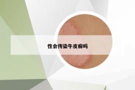 性會傳染牛皮癬嗎