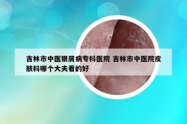 吉林市中醫(yī)銀屑病專科醫(yī)院 吉林市中醫(yī)院皮膚科哪個大夫看的好