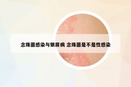 念珠菌感染與銀屑病 念珠菌是不是性感染