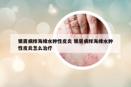 銀屑病樣海綿水腫性皮炎 銀屑病樣海綿水腫性皮炎怎么治療