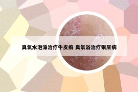 臭氧水泡澡治療牛皮癬 臭氧浴治療銀屑病