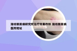 濰坊銀屑病研究院治療效果咋樣 濰坊銀屑病醫(yī)院地址
