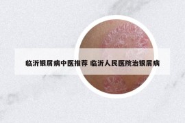 臨沂銀屑病中醫(yī)推薦 臨沂人民醫(yī)院治銀屑病