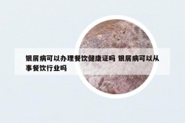 銀屑病可以辦理餐飲健康證嗎 銀屑病可以從事餐飲行業(yè)嗎