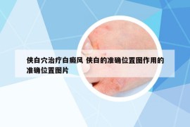 俠白穴治療白癜風(fēng) 俠白的準(zhǔn)確位置圖作用的準(zhǔn)確位置圖片