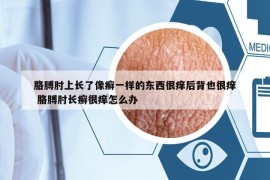胳膊肘上長(zhǎng)了像癬一樣的東西很癢后背也很癢 胳膊肘長(zhǎng)癬很癢怎么辦