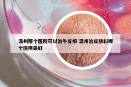 溫州那個(gè)醫(yī)院可以治牛皮癬 溫州治皮膚科哪個(gè)醫(yī)院最好