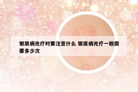銀屑病光療時(shí)要注意什么 銀屑病光療一般需要多少次
