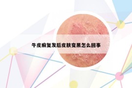 牛皮癬復(fù)發(fā)后皮膚變黑怎么回事