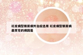 紅皮病型銀屑病外治應(yīng)選用 紅皮病型銀屑病最常見的病因是